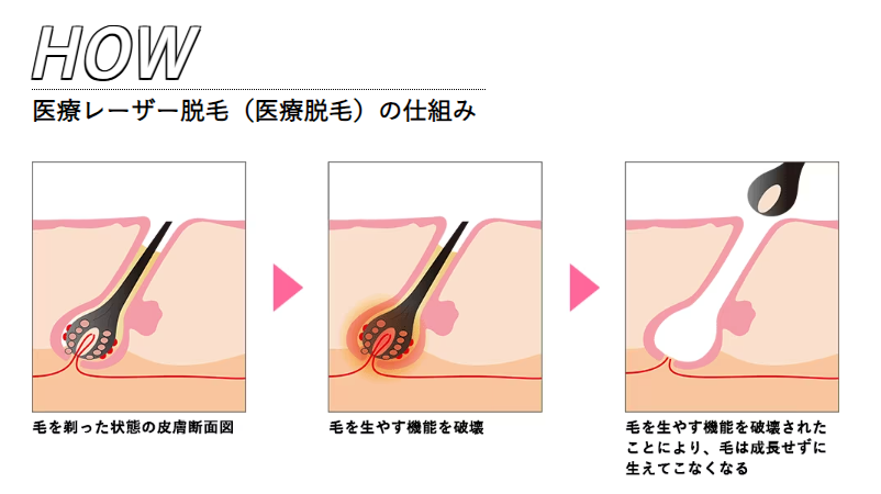 湘南美容クリニック　医療レーザー脱毛の仕組み